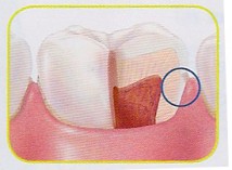 Caries Mallorcadent