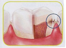 Caries Mallorcadent