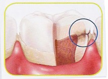 Caries Mallorcadent