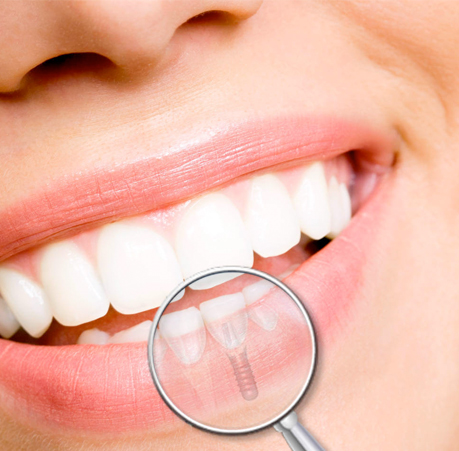 Implantes Dentales