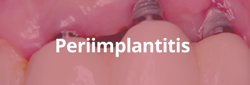 Periimplantitis