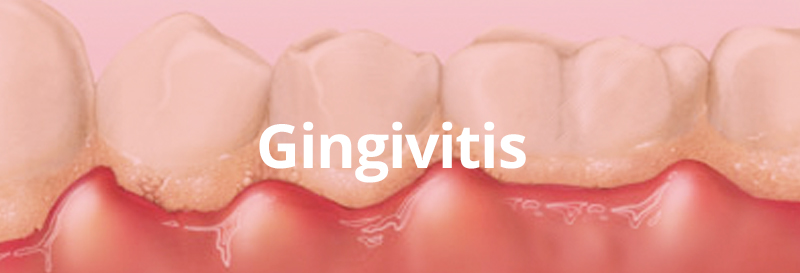 Gingivitis